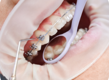 dentist-attaching-metal-braces-patient-teeth